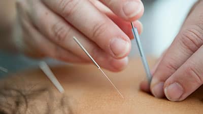 accupuncture